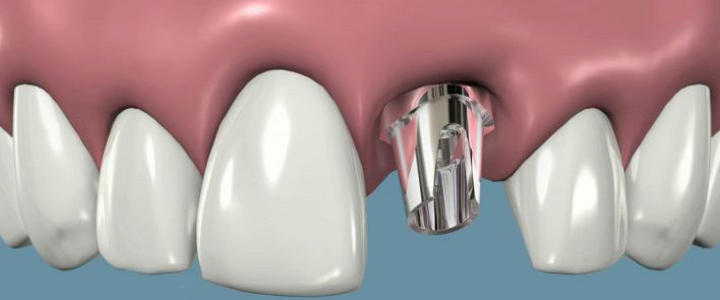 Dentista Milano Domande e risposte sull'Implantologia